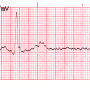 ecg-filter-ac50-emg25-dft.png