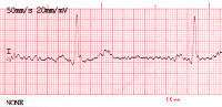 ECG con filtri AC50Hz, EMG25Hz e DFT