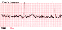 ECG senza filtri attivi