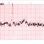 ecg-filter-none.png