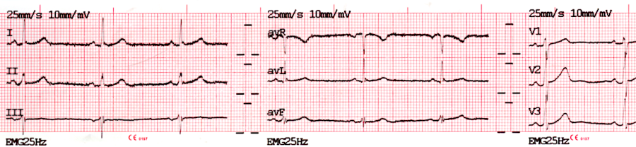 ecg-print-3x4.png ecg-print-3x4.png