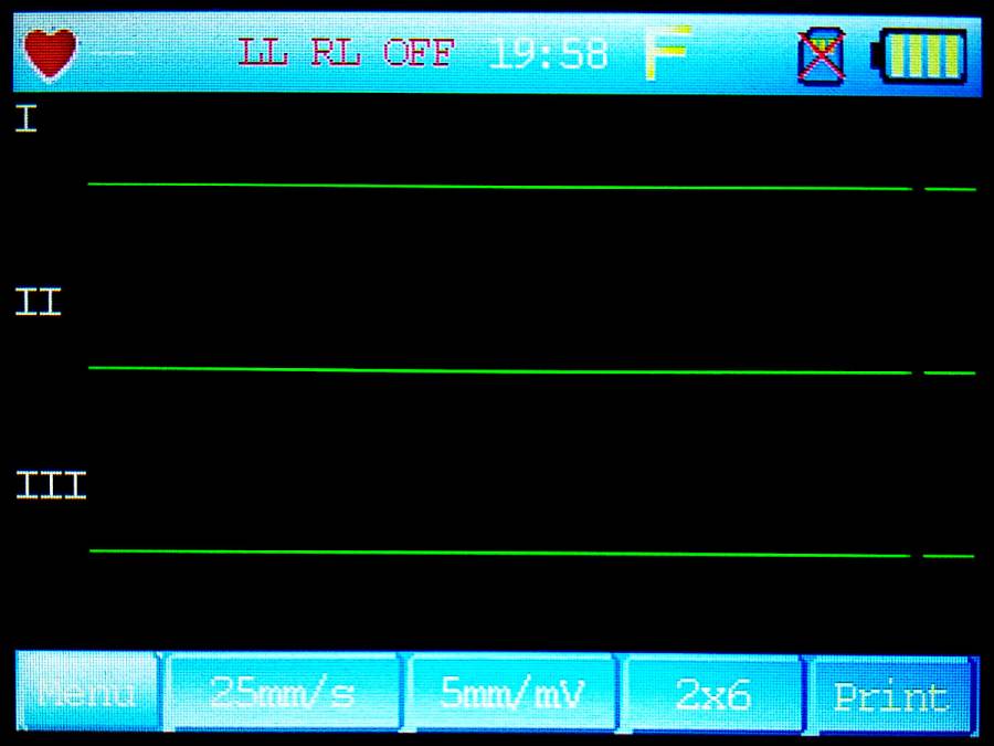 ecg90a_ecg-graph.jpg