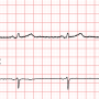 ecg90a_filter-emg25hz.png