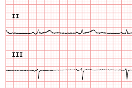 ECG90A - Filtro EMG25Hz