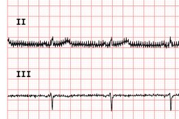 ECG90A - Nessun filtro attivo