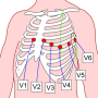 precordial_leads_2.png